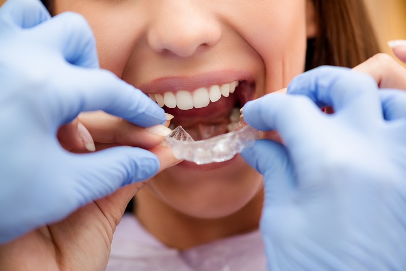 Invisalign-Dentist-Puyallup-WA